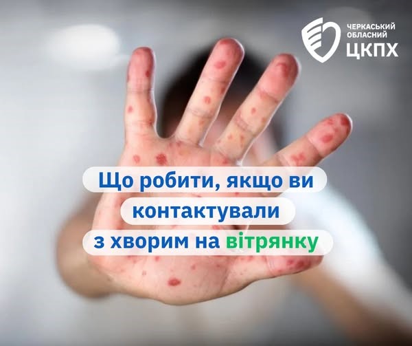 Що робити, якщо ви контактували з хворим на вітрянку?
